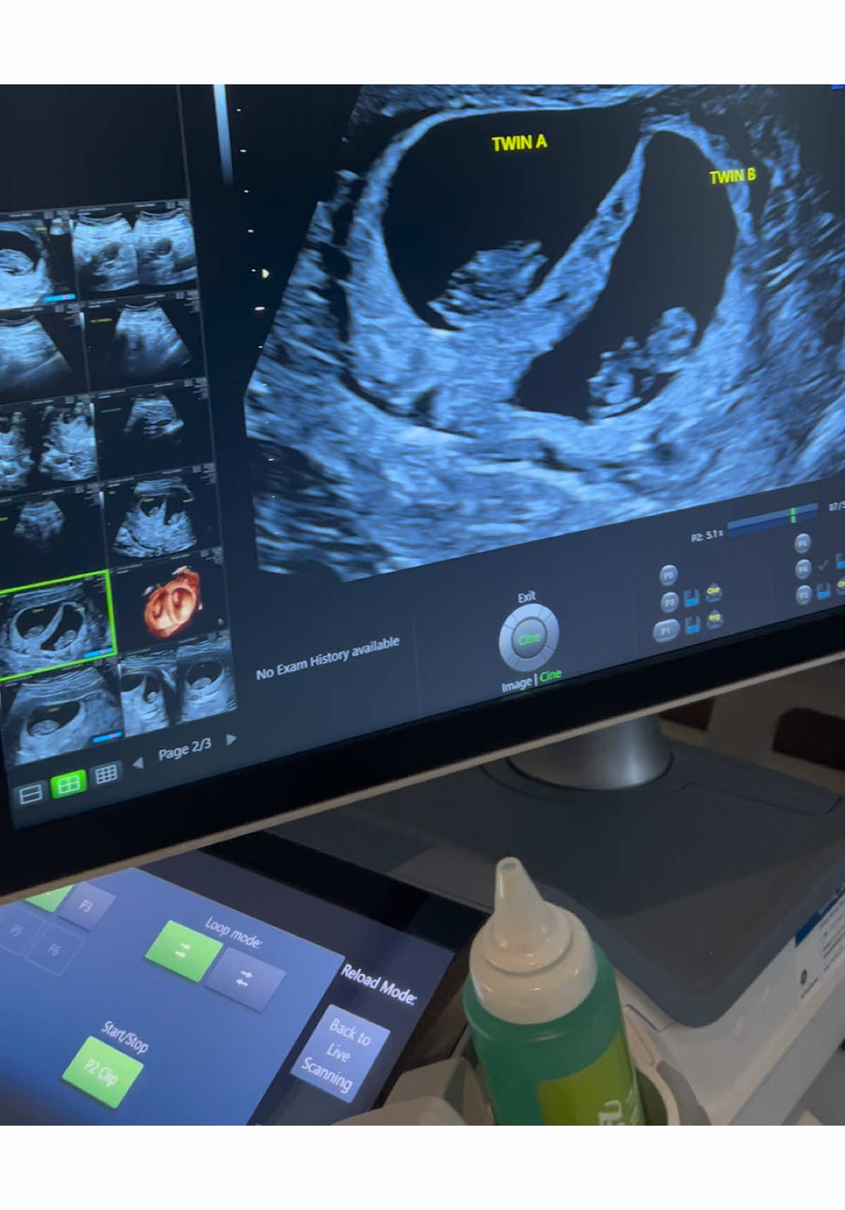 Twins at 8 weeks 🥺 #blessing #twins #pregnancy #ultrasound 