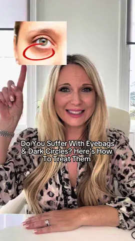 Many of us suffer from dark under eyes and circles 👁️ Here’s what might be causing it and how to solve this common issue. It might be caused by iron deficiency, aging or a genetic predisposition. Opt for great targeted skincare, sun protection☀️ or in-clinic treatments such as tear-trough filler. Have you tried any of these to improve your dark circles? Let me know how you got on. #undereyes #aesthetics #healthyskin