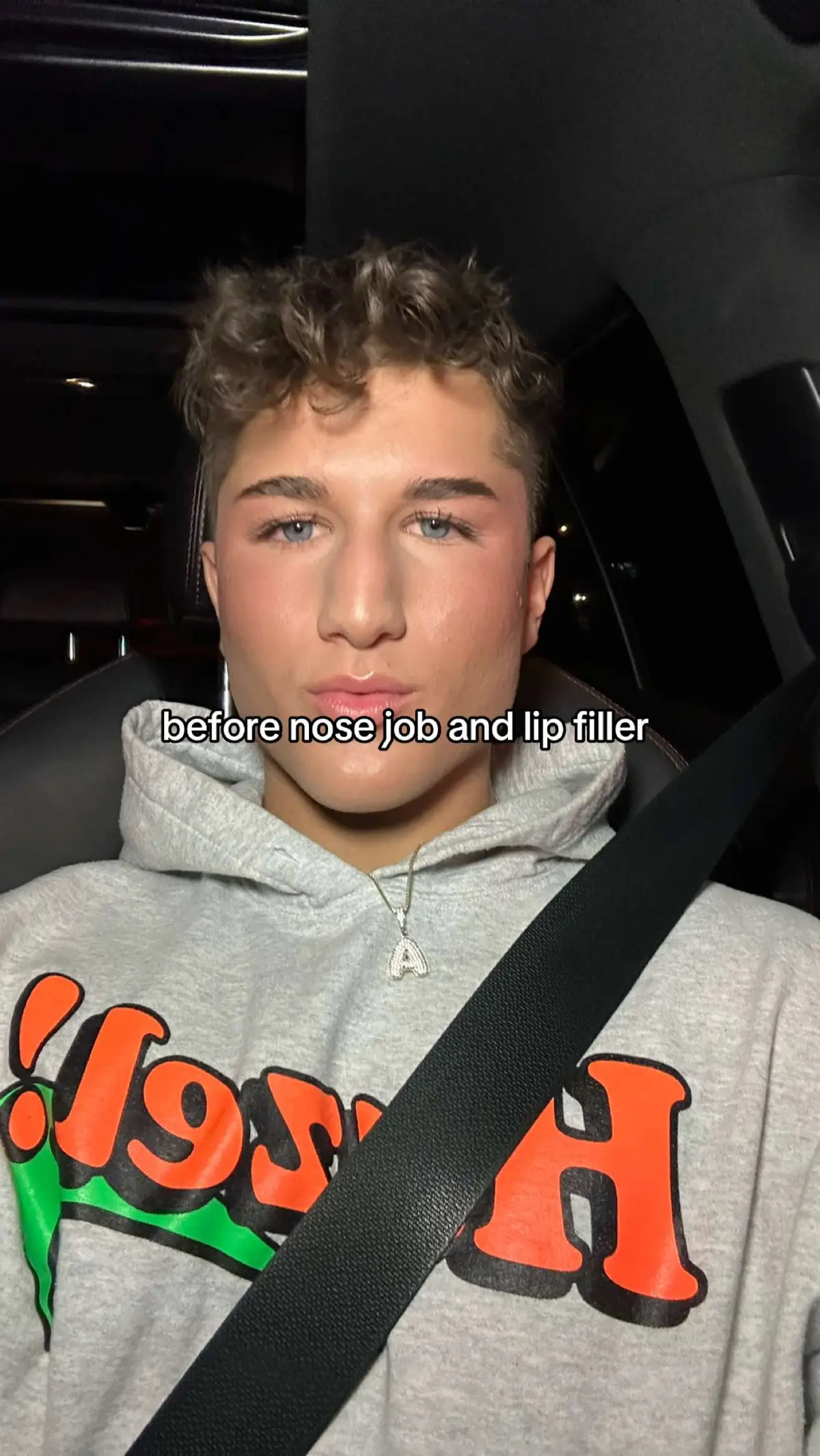crazyyyy #lipfiller #nosejob 