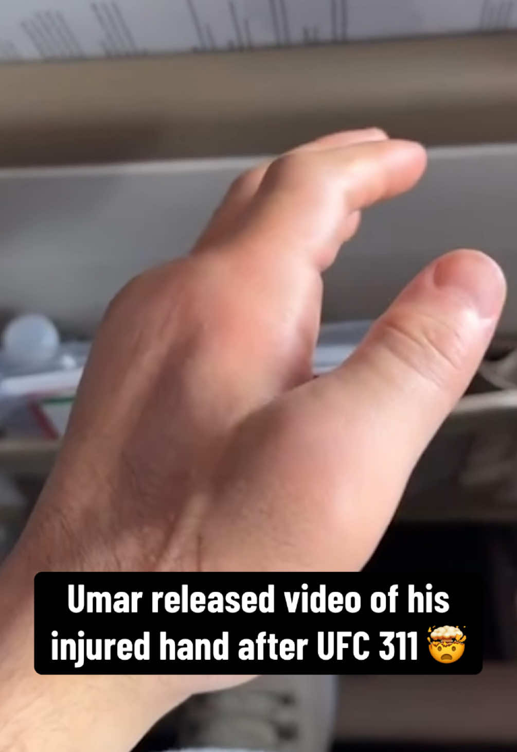 The swelling on #umarnurmagomedov’s hand 😳 #UFC #mma #ufc311 #ouch #injury (via umar_nurmagomedov/IG)