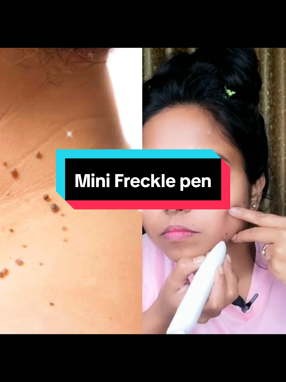 Adopt high performance electric ion technology to effortlesly and instantly remove and sweep freckles✨ #minifrecklepen #formolefreckleremover