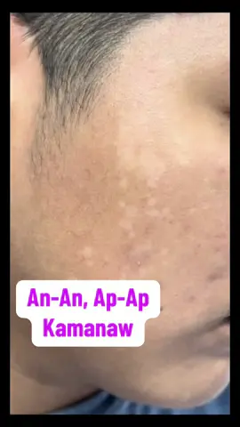 Try this product Akiika Ointment #Akiika #skinproblem #allergy #herbalcream #ointment 