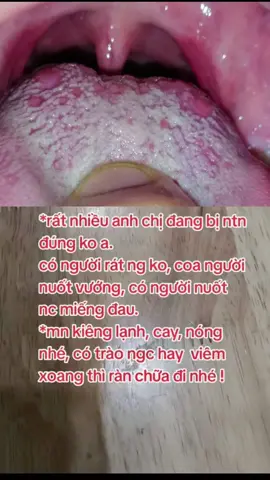 C.ó ai đang bị viêm họng hạt,viêm amidan họng lúc nào cũng có đờm ,cứ vướng mắc khó chịu ở cổ khạc mãi không ra.đờm nhiều khi nằm. phải khịt đờm xuống họng để khác nhổ, nuốt nghẹn,đau rát, viêm xoang chảy dịch xuống họng ,nhiễm hp trào ngược dạ dày ợ hơi, tức ngực, khó thở, buồn nôn lúc đánh răng,..ai bị gửi tin nhắn em chỉ cho cách dtri khỏi tại nhà  ko cần uông thuôc  tây.#viemhong #viemhonghat #viemhongmantinh #amidan #traonguocdaday #viemxoang #trangluoi #suckhoechomoinguoi #baithuochay #xuhuongtiktok 
