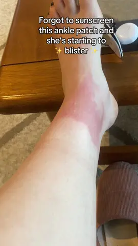 It hurts to wear socks 😭 #sunburn 