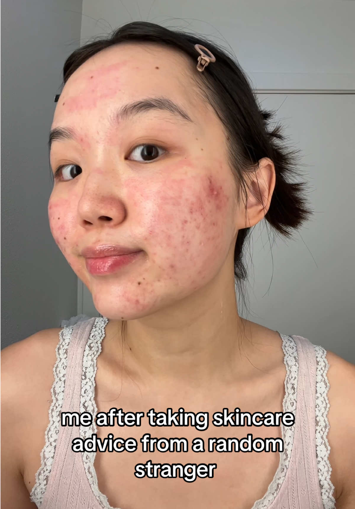 Lesson learned 😀 #acne #skincare #breakout #blemishes #hyperpigmentation 
