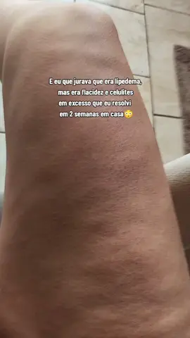 minhas pernas mudaram tanto depois que eu comecei a usar esse creme ✨✨🦵🏻 #celulite #flacidez #lipedema #pernasgrossas 