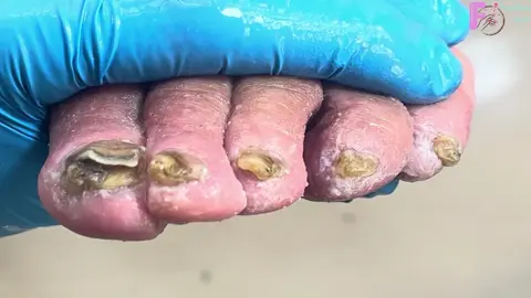 _Wow. The whole toe is infected, dealing with poor onychomycosis #toenail #pedicure #naildesigns #ingrownnail #nailtutorial #nails #nail #fungusnailstreatment #ingrowntoenail #nailart #viraltiktok #nailsartvideos #fungusnails #fungus #viralvideo #viral #修脚 #trending #nailpolish #trend #móng #móngtayđẹp