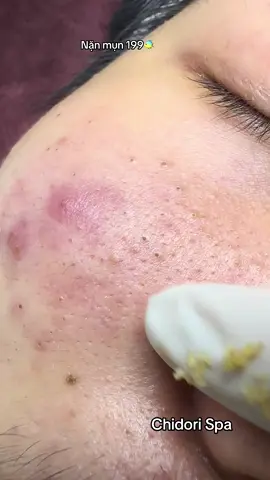 Tín hiệu vụ trụ đang gửi đến các bạn đi làm đẹp ăn tết😗 #nanmunquan7 #spaquan7 #lamdep #nanmun #chidorispa #lamdepkhongkho #nặnmụnởquận7 #trimunquan7 #nanmunbangtayquan7 #nanmunquan3 #xuhuong #fyp 