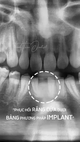 Dù là răng cửa hay răng hàm, cấy ghép implant là giải pháp hoàn hảo giúp bạn khôi phục nụ cười tự tin và chức năng nhai tự nhiên. 💎 Nhanh chóng, an toàn và bền lâu! Hãy để chúng tôi đồng hành cùng bạn trên hành trình lấy lại nụ cười hoàn hảo! 🌟#fyp #xhh #impalnt #lamdep #taytrangrang #dansuveneer #rangsuthammy #niengrang #nhakhoathanhtrieu #nhakhoauytin #tet2025 