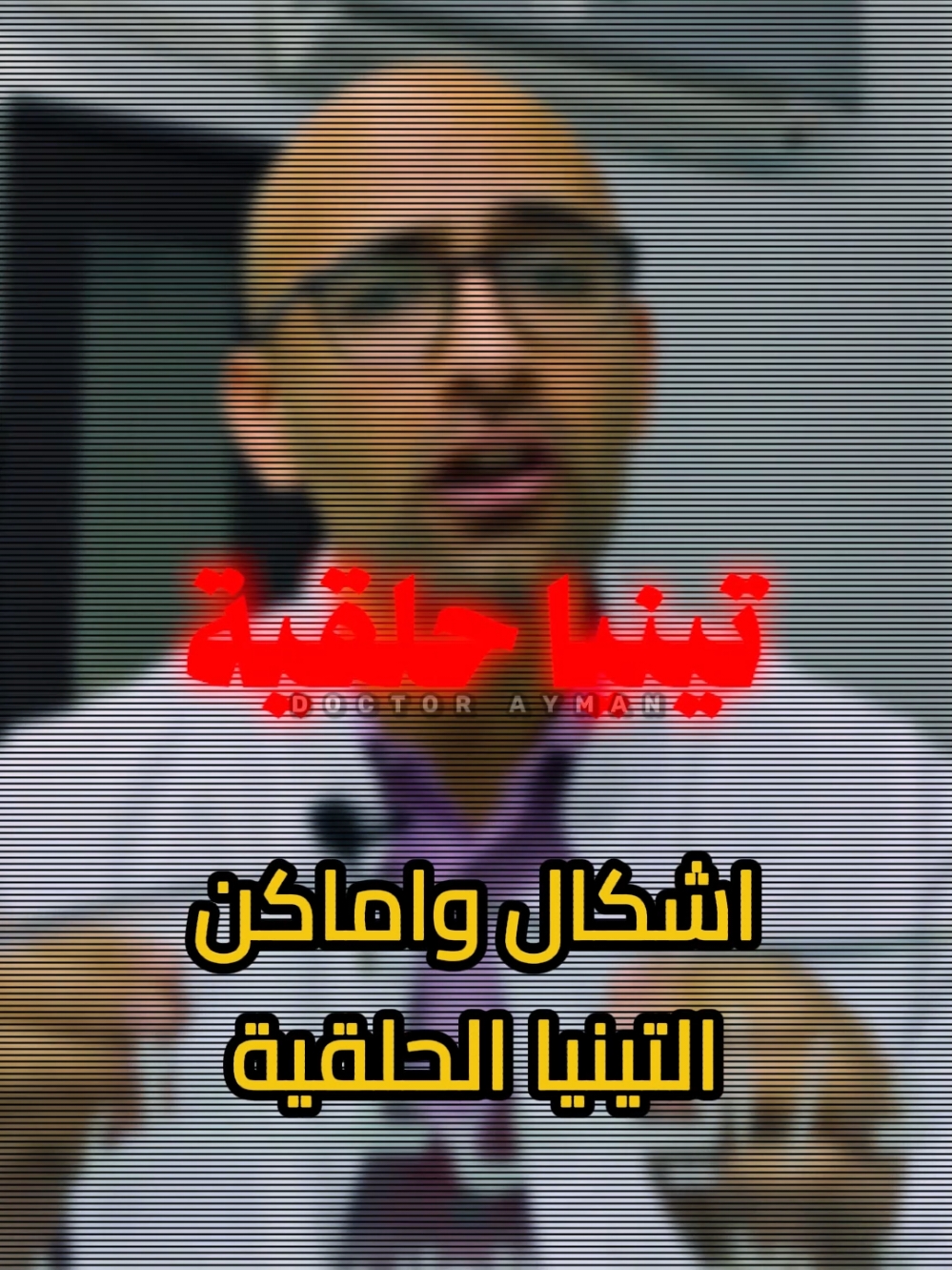 ما هي التينيا الحلقية ؟ سببها و اشكالها #دكتور_ايمن #Doctor_Ayman #التينيا_الحلقية 