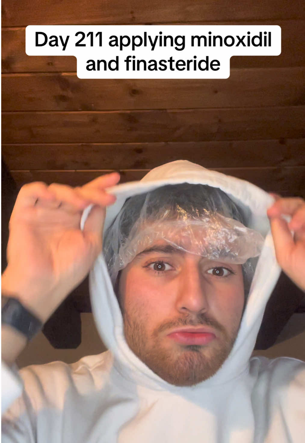 Video un po’ vecchio 🫤#primaedopo #beforeandafter #hairtransplant #hairstyle #hair #asmr #finasteride #minoxidil #hairroutine #haircare #beauty #alopecia #bald #hairloss 