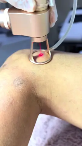 Scar removal co2 fractional laser treatment.  Vialey Nail Spa & Aesthetic Clinic