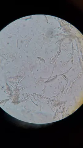 Candidíase na Urina. Formação de pseudohifas. #candidiase #analisesclinicas 