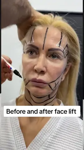 Before and after face lift  #facelift #faceliftsurgery #faceliftchallenge #plasticsurgery #fatinjection 