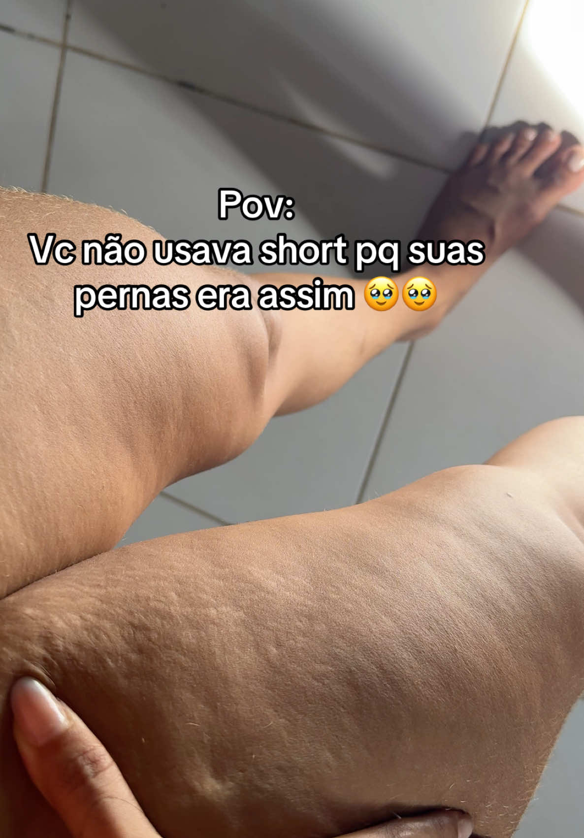 Eu tô amando! Valeu a pena cada centavo! #lipedema #flacidez #foliculite #celulite 