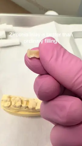 Zirconia inlay #зубы #dental #hounslow #dentalcare #crown #toothpaste #dentistlondon #Зубнойврач #aesthetic #painfree #caredental #dentist #dentisthounslow #angelovanota 