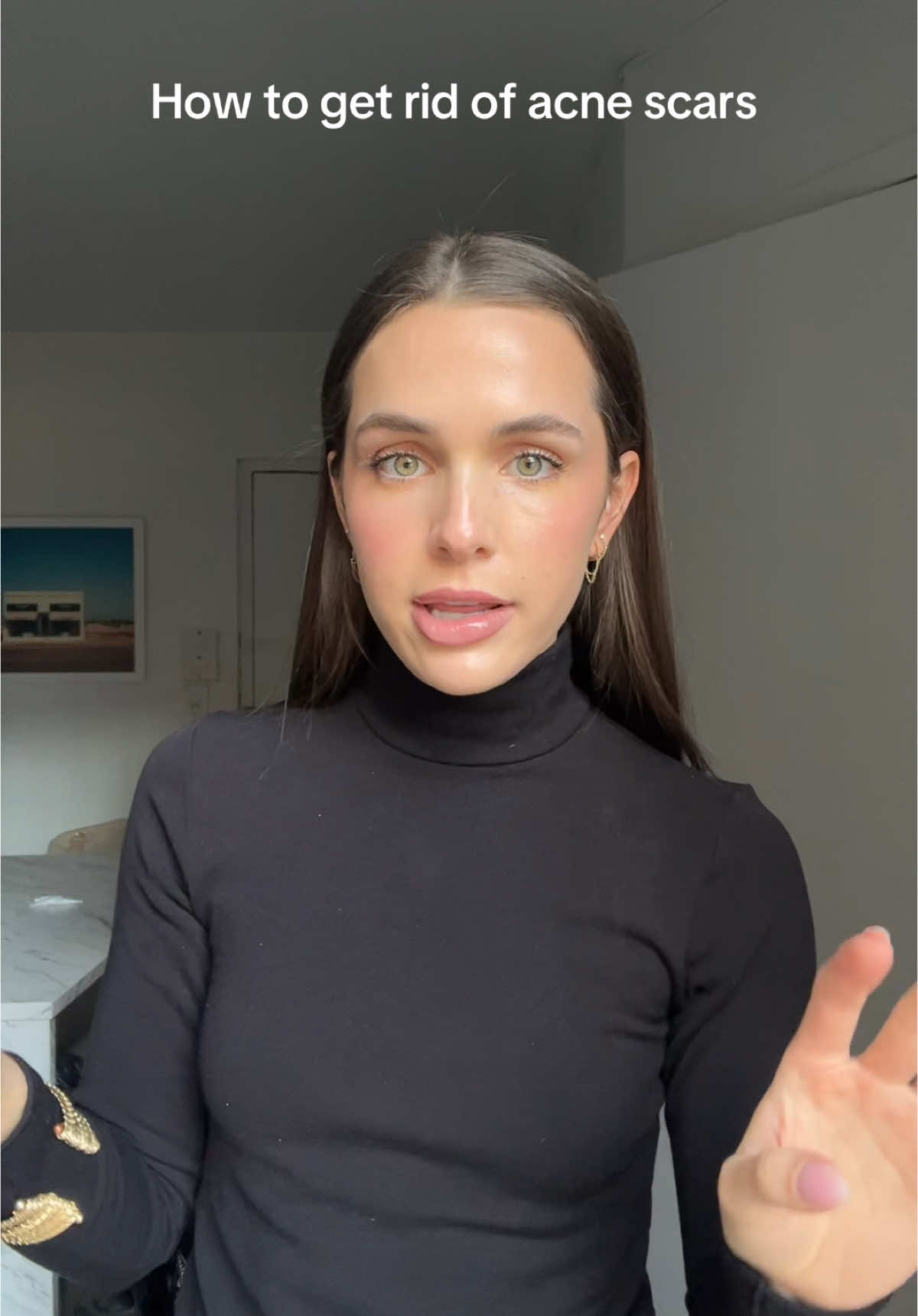 the best 3 things that helped my acne scars #acnescars #acnescarsremoval #acnetips #clearskin #glowingskin #clearskintips #microneedlingtherapy @Velour Medical @Cyma, NP • NYC Botox & Filler @Caudalie @EltaMD Skin Care 