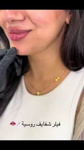 #lipfiller#BeautyTransformation#filler #شفايف_روسية#مصر🇪🇬 