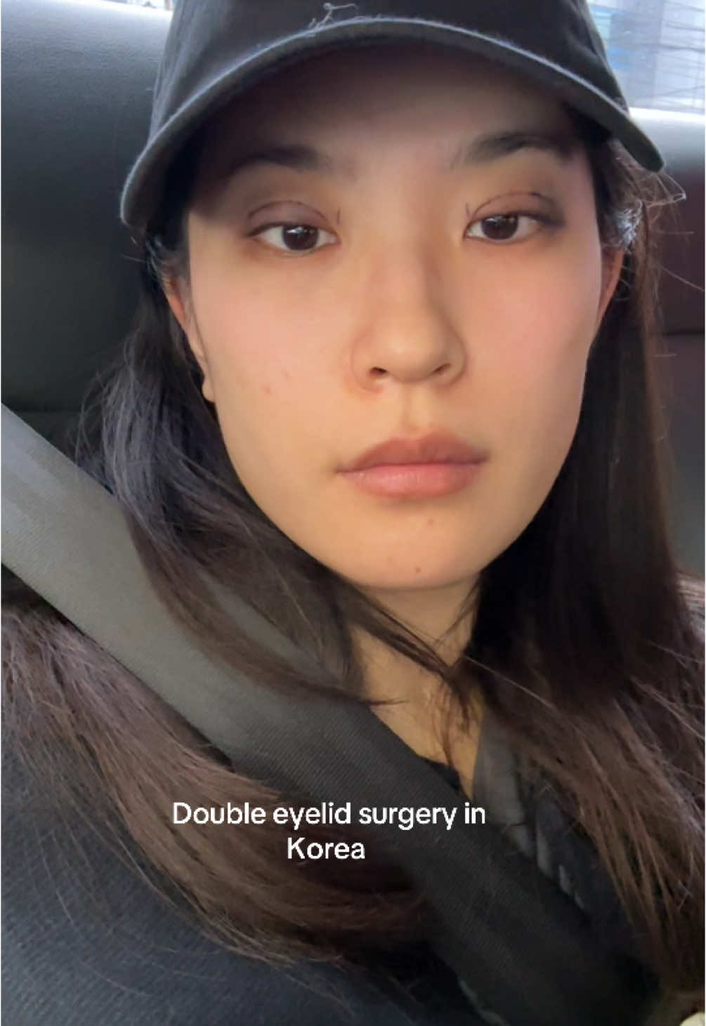 I got a lot of questions on my other videos so I thought this summary would be helpful! Again, not promoting PS.  #doubleeyelid #seoul #seoultravel #koreaplasticsurgery #korea #plasticsurgery #eyelidsurgery #gangnam 