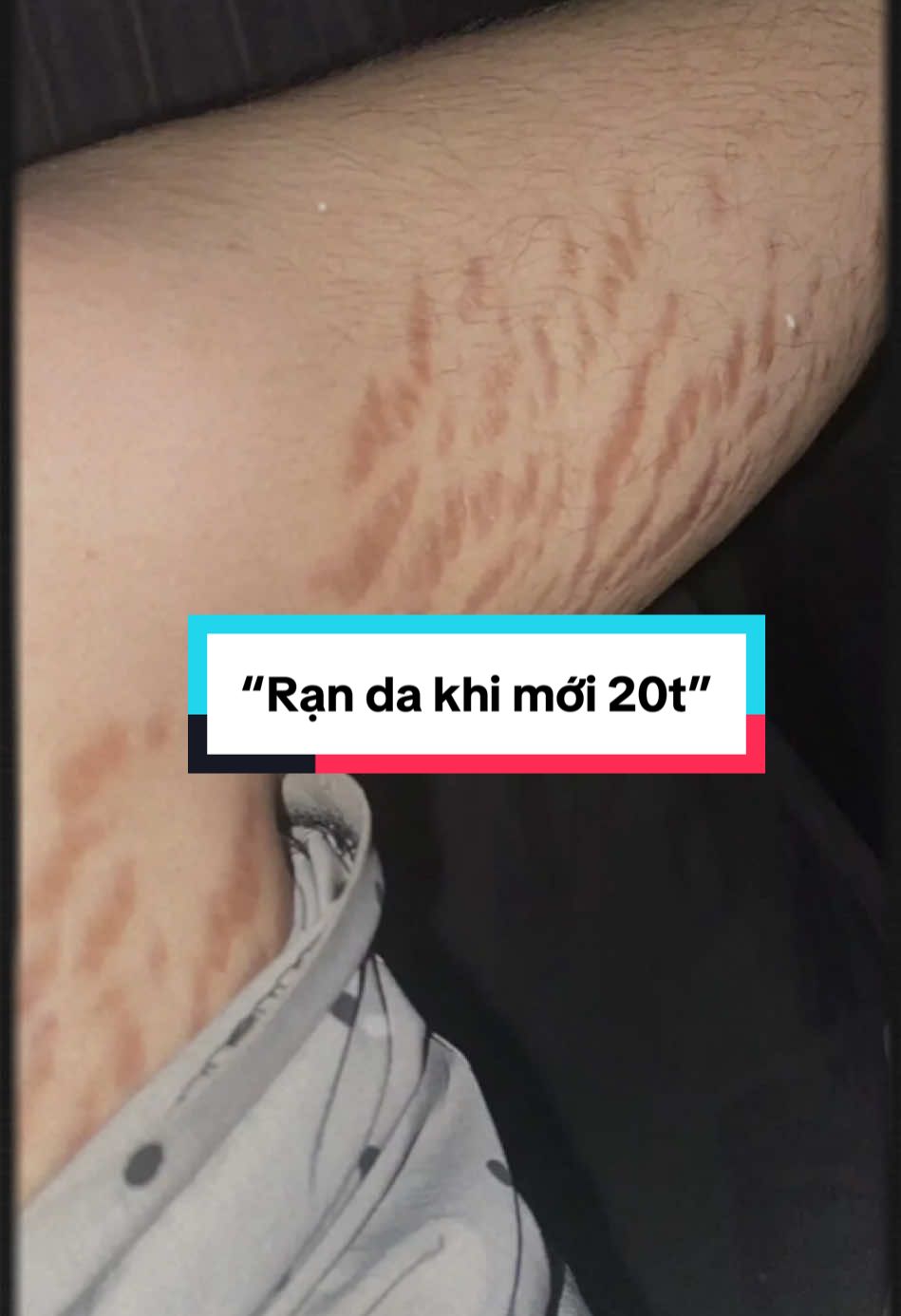 Cứ nghĩ rạn da chỉ xảy ra khi mang thai hoặc sau khi sinh em bé, cho tới khi nó xuất hiện trên cơ thể của cô gái 20  tuổi như mình #ovelaabera #rạnda #kemranda #feedback 