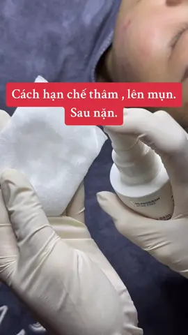 #mụn #peel #chemicalpeel #thâm 