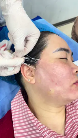 Căng chỉ Full Face  #giữgìnnhansắc #căngcơ #xoánhănđuôimắt #chốnglãohoágiúpdasángđẹpcăngbóng #Trẻlâu #căngbóng #xoánhănđuôimắt #căngchỉtreolôngmay #reviewlàmđẹp #căngdamặttrehoa 