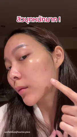 รีบใช้เร็วแค่ไหน รอยสิวหน้าใสก็มาเร็วเท่านั้น #เซรั่มชิโรอิ #เซรั่มหน้าใสชิโรอิ3in1 #เซรั่มลดรอยสิวชิโรอิ #Shiroi #ลดรอยสิว #หน้าใส #สกินแคร์