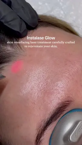 Instalase glow✨ #skinresurfacing #skin #glow #laser #skinlaser #rejuvenation 