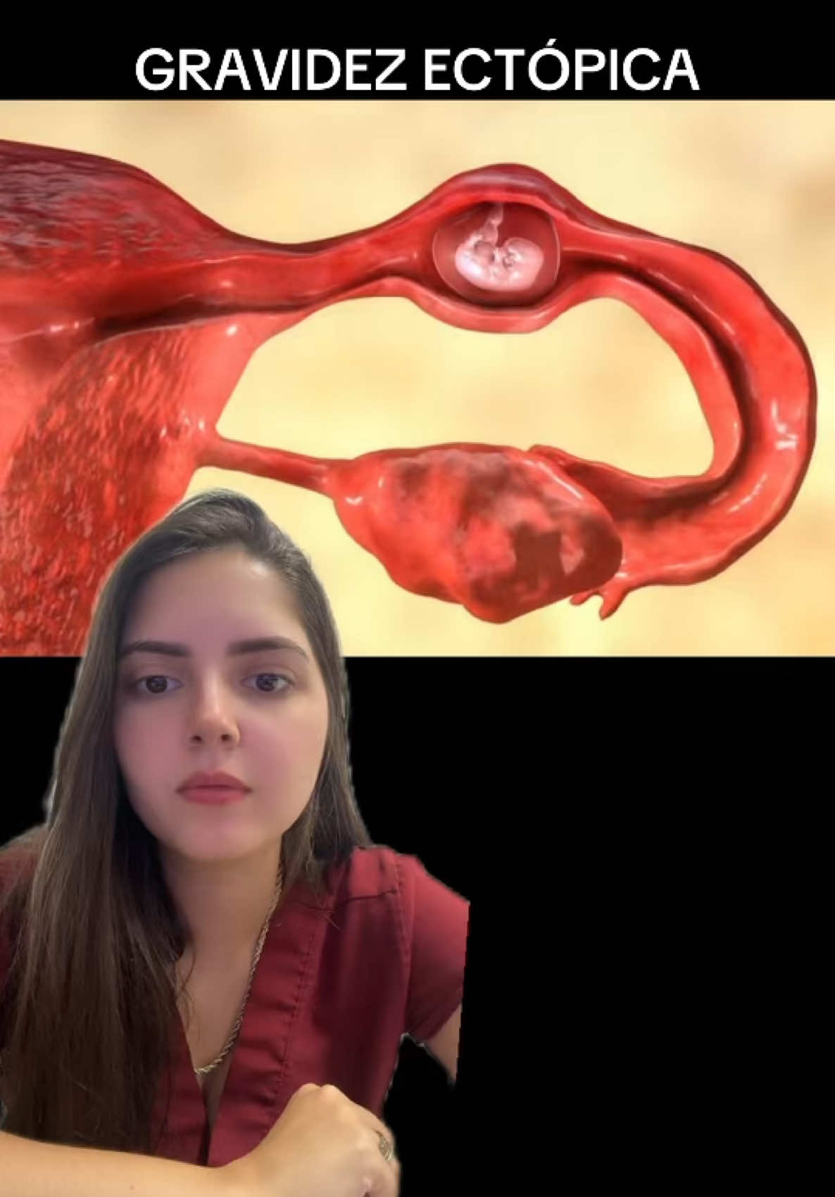 Você conhece alguém que teve uma gestação ectopica? #gestante #ultrassom #gestacaoectopica #prenatal #metotrexato #laparotomia #trompas #obstetra 