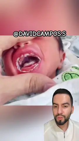 Muguet en la boca #candidiasis #muguet #sapito #drdavidcampos 