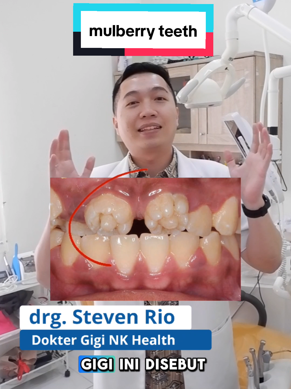 kasus gigi mulberry teeth, apa itu ? #mulberryteeth #doktergigi #nkhealth #sehatbersamankhealth 