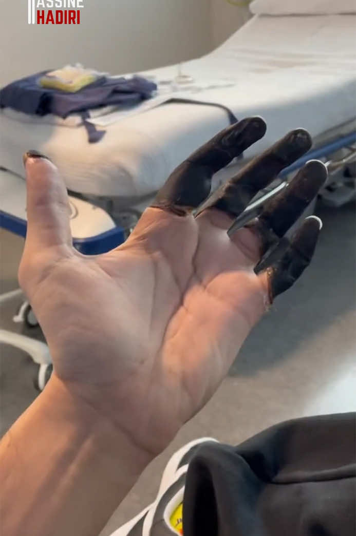 قضمة الصقيع Frostbite وموت الخلايا Necrosis/Apoptosis #علوم #بيولوجيا #صحة