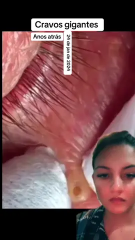 #anosatrás #cravos #terapia #reagindo #limpezasatisfatoria essa limpeza de pele 