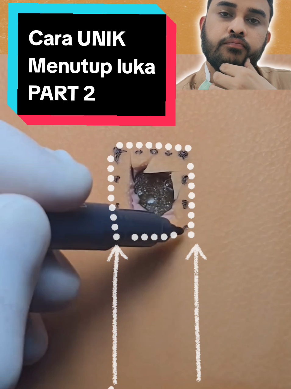 Advancement flap adalah teknik bedah untuk menutupi defek kulit dengan menggerakkan kulit yang berdekatan. Teknik ini biasanya digunakan untuk memperbaiki cacat kulit di area dahi, kulit kepala, kelopak mata, dan bibir atas.  Prinsip kerja advancement flap:  Membuat insisi tangensial berbentuk pedicle persegi panjang terhadap defek Memperpanjang jaringan dengan mengubah sudut jaringan Memindahkan garis eksisi sehingga lebih kosmetis credit : ig dr_vodopianov #fyp #wound #skinflap #plasticsurgeonsoftiktok #plasticsurgeonexplains #plasticsurgery #keloid #keloidremoval  #CapCut 