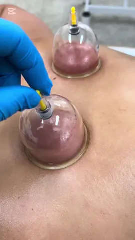 #الحجامة_النبوية #الحجامة_شفاء #الحجامة_شفاء #حجامة_جافة #الحجامة_الطبية #الحجام #cupping #حجامة_علاجية #الحجامة #المغرب🇲🇦تونس🇹🇳الجزائر🇩🇿 #hijama 