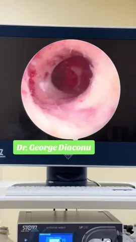 Histeroscopie diagnostica - live Polip endometrial, endometrita, istmocel/nisa uterina. - Excizie polip endometrial pe cale histeroscopica; - Termocoagularea vaselor de neoformatie din zona istmica #TheVaginaDoc #drGeorgeDiaconu #histeroscopie #polipendometrial #istmocel #nisauterina #endometrita 