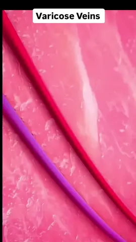 varicose veins disease  #vericoseveins #vaeicoseveins #learners #lifefacts #fypシ゚viral🖤tiktok #scienceanimations 