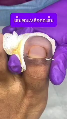 เล็บขบตัดออกไม่หมดคะ#ingrowntoenail #wefootตัดเล็บขบรักษาเล็บเชื้อรา #เล็บขบหนักมาก #ตัดเล็บขบมียาชา #เล็บขบ #ตัดเล็บขบ #ตัดเล็บขบ #เล็บขบอักเสบ 