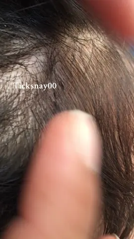 Remove lice #omg😱😱😱 #lice #tripofobia😮😥 #liceremoval 