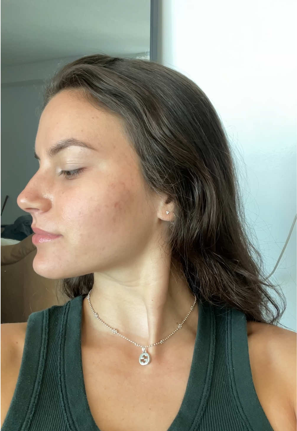 i don’t even recognize myself #acne #skincare #acnejourney #acneskin #transformation #clearskin #accutane #purge 