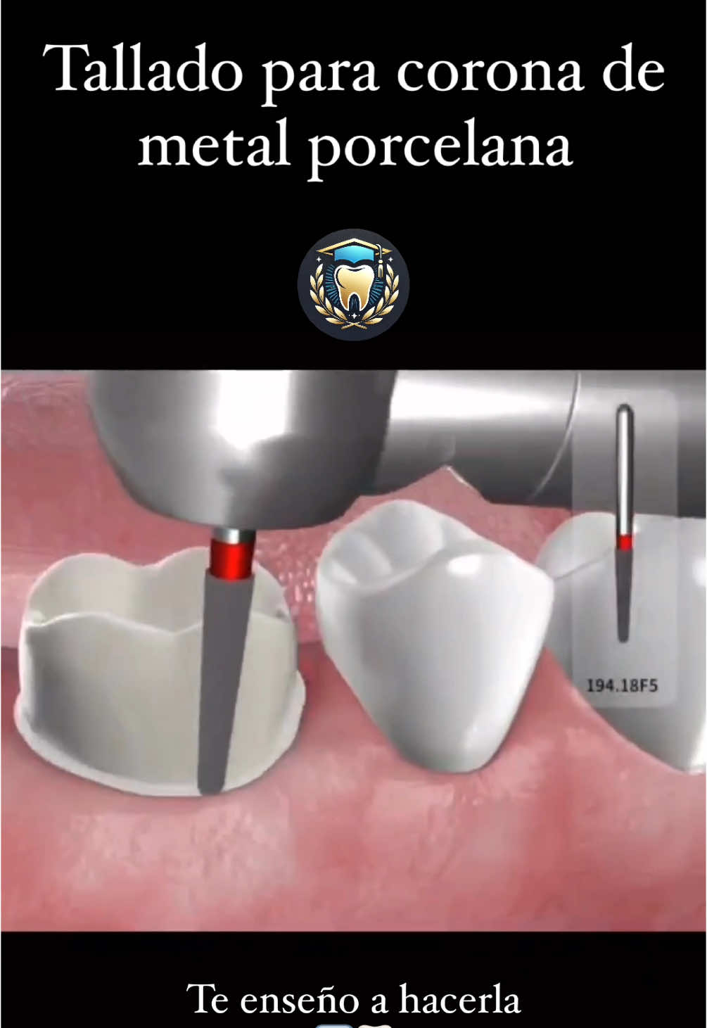 6 tips avanzados para el tallado de una corona metal-porcelana en posteriores 🦷✨ 1. Desgaste preciso: 2 mm en cúspides funcionales y 1.5 mm en no funcionales para evitar fracturas de porcelana. 2. Bordes redondeados: Evita ángulos internos agudos; distribuyen mejor las fuerzas y reducen riesgos de fractura. 3. Hombro vestibular: 1.2-1.5 mm para porcelana; en lingual usa un chámfer para optimizar el espacio para el metal. 4. Convergencia axial: Mantén 6° para retención sin comprometer la inserción de la corona. 5. Guías oclusales: Marca antes del desgaste para conservar la anatomí­a funcional. 6. Pulido final: Fresas de grano fino eliminan irregularidades y mejoran la adaptación marginal. Detalles que elevan tus restauraciones.  Síguenos para más tips de odontología que te harán el día a día mucho más sencillo!! @odontologiainternacional #TalladoDeCoronas #TecnicasAvanzadas #Educaciondental#OdontologiaAvanzada #Dental
