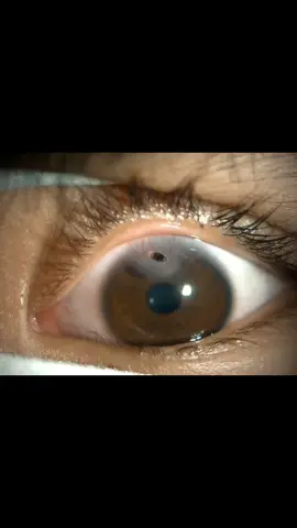 สิ่งแปลกปลอมเข้าตา #เพชรบูรณ์คลินิก #เพชรบูรณ์คลินิค #ตรวจตาเพชรบูรณ์ #จักษุแพทย์ #หมอชัยชาญ #เพชรบูรณ์ 