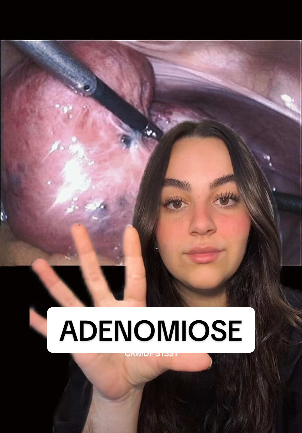 Lhes apresento: Adenomiose ✨ #adenomiose #endometriose 
