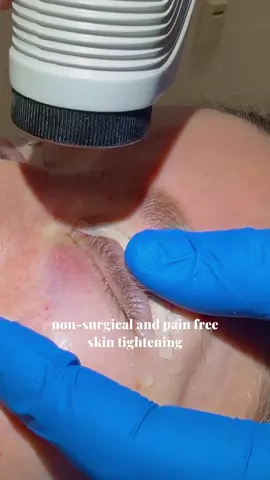 Dunkle Augenringe und feine Fältchen? Nicht mehr mit mir!  Wir haben den CO2-Laser ausprobiert, und das Ergebnis ist einfach WOW! ✨ Diese innovative Behandlung reduziert Falten, Pigmentierungen und lässt die Haut unter den Augen frischer und strahlender aussehen. ✔ Effektive Hauterneuerung ✔ Minimal-invasive Methode ✔ Strahlende Ergebnisse nach nur wenigen Sitzungen Die perfekte Lösung für einen wachen, jugendlichen Look!  Wer hat’s auch schon probiert? Schreibt mir eure Erfahrungen in die Kommentare!  #CO2Laser #AugenringeAdé #StrahlenderBlick #Hautpflege #Laserbehandlung #AntiAging #SchöneHaut #GlowUp