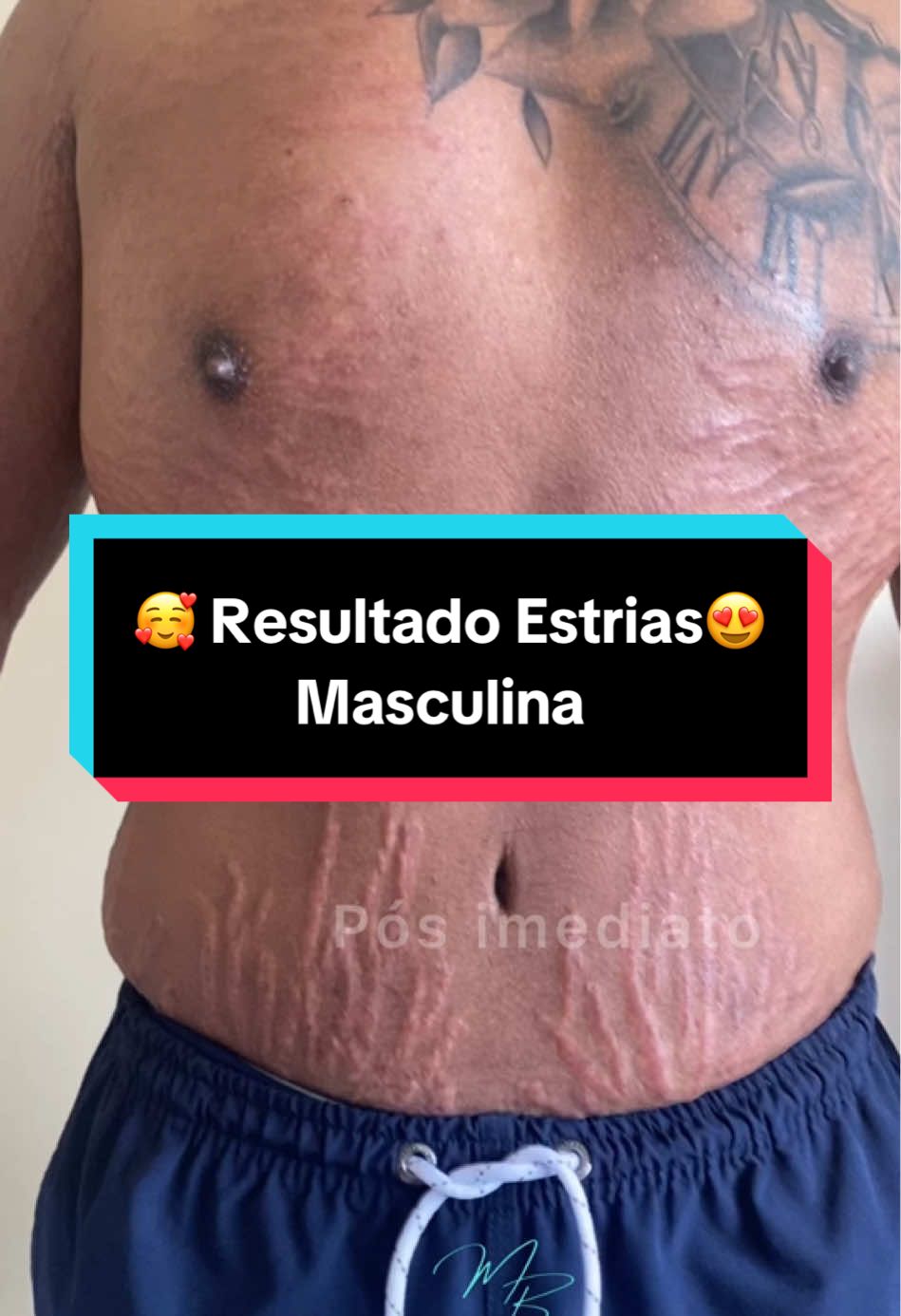 Resultado com apenas uma única sessão.    Existe tratamento que entrega resultados e devolve autoestima.  . . #estética #dicas #viral_video #tratamento #videoviral #labios #clareamento #dicasbeleza #estrias #estriasvermelhas #camuflagemestetica #botox #pele 