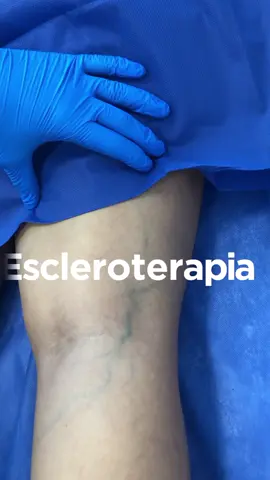 💉✨ Dile adiós a las varices y recupera la confianza en tus piernas con la escleroterapia. Este tratamiento no invasivo ayuda a eliminar esas venitas molestas de forma rápida y efectiva. 🌟   Agenda tu consulta hoy y descubre lo fácil que es cuidar de tu piel. 💙 ¡Vocación que corre por nuestras venas! 📍Kennedy Norte, Cdla Albatros, Calle 12A, 1er pasaje N.8 (Frente a la Clínica San Francisco) Guayaquil - Ecuador #escleroterapia  #adiósvarices #varices  #cuidadopersonal  #saludvascular  #clinicavascular  #piernassinvarices  #salud  #bienestar  #juntosporti  #ecuador #guayaquil #fyp 