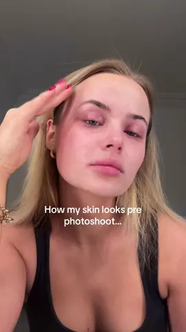 I try not to let eczema ruin my dreams ❤️ This morning I woke up feeling so insecure about my eczema, knowing I was modeling for @Blend Cosmetics feeling embarrassed for the makeup artist having to try cover my eczema up. However the second I got there everyone was so lovely and made me feel so comfortable about my eczema. They also altered their makeup products to fit my allergies. Just shows you that life is more than a skin condition. (I also appreciate that I am very grateful my eczema isn’t too bad at the moment and some people experience it worse. I am very lucky 🥰) #eczema #eczemaawareness #eczematok #eczemahealing #eczemaflareup #eczemawarrior #eczemacheck #eczematiktok #eczemacommunity #model #modelling #modellife #eczemadiaries #CapCut 