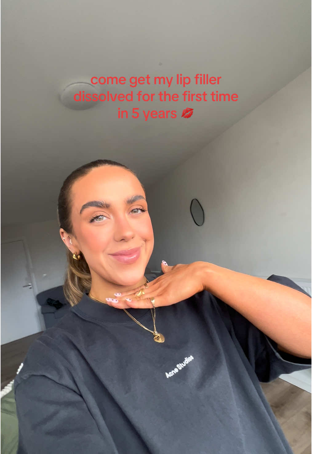 TW:// there are needles in this video :// I’ve been getting my lips done since the end of 2019, it’s time to start fresh again 💋💋  There’s no one else I’d trust with my lips than @KerryHanaphy ❤️❤️  #lipfiller #lipdissolving #ireland #dublin #lips 