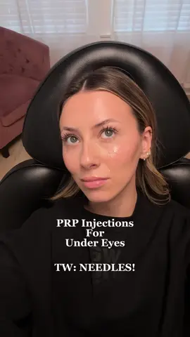 PRP Round 3 - I am starting to see the results 🤯 #prpundereye #prp #prpundereyes #prpinjection #darkcircles #medspa #aesthetic #injectables #plasticsurgery #dallascreator #upkeepmedspa 