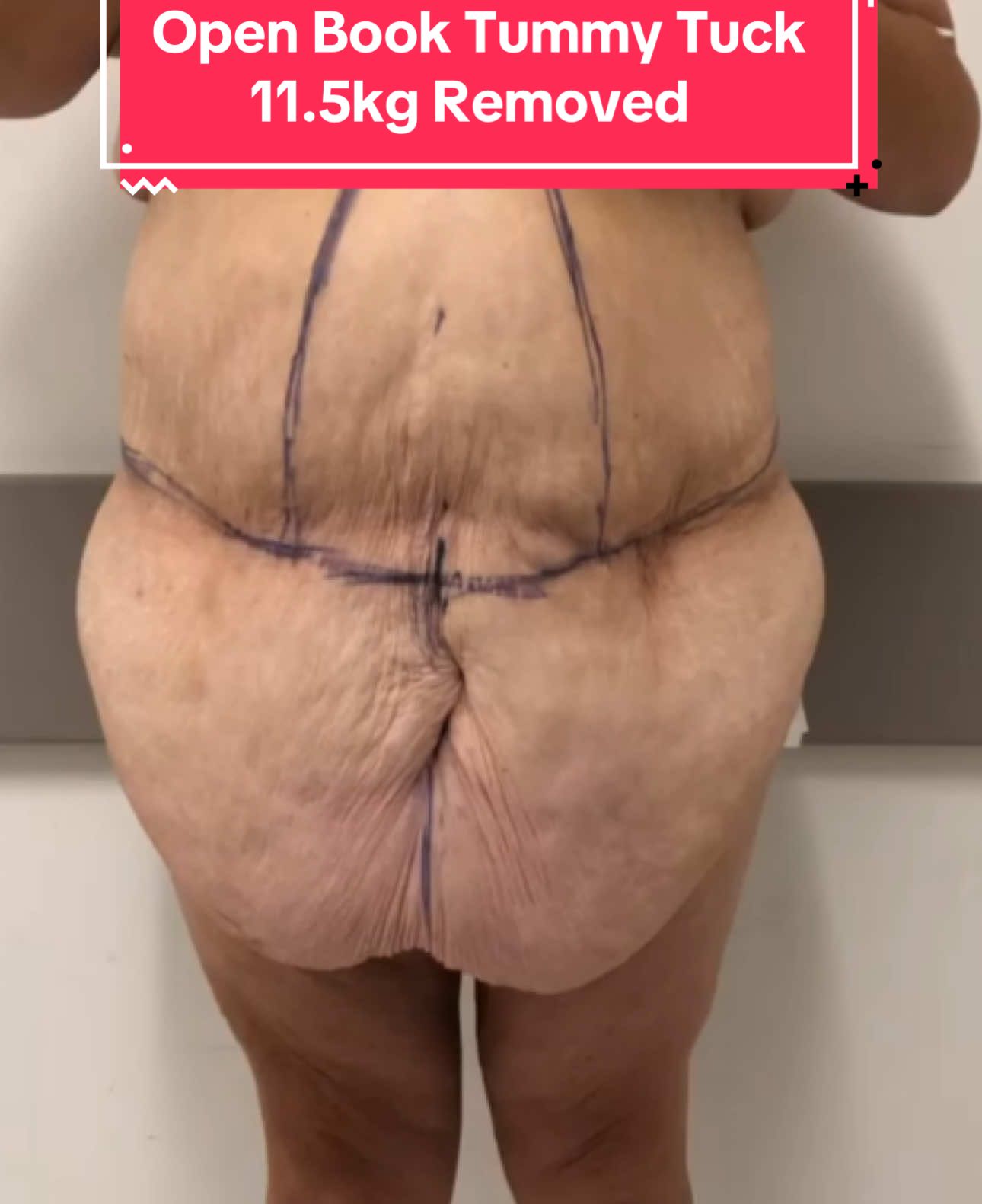 OPEN BOOK TUMMY TUCK ™ (Abdominoplasty) & BELT LIPECTOMY Dr Dona explains what an Open Book Tummy Tuck is and why some patients would benefit from this Body Contouring Surgical procedure.  Patients that are having an Open Book Tummy Tuck often require a Belt Lipectomy to optimise the results.  This patient had lost over 80kg’s and required a total body reconstruction - Dr Dona removed 11.5kg of excess skin and fatty tissue as part of her surgery.    Experience & Excellence in Plastic Surgery is what you deserve #DrEddyDona #OpenBook #TummyTuck #Abdominoplasty #PlasticSurgery  DISCLAIMER: All surgeries on this page are performed by Dr Eddy Dona, and are published with the written consent by the patients. Before & after images are generally shown between 3-6 months post-surgery.  All surgery carries risks, requires recovery time, and the results will vary for each individual patient. The content on this page is general in nature and is not a substitute for a formal consultation.  Before proceeding please seek medical advice from an appropriately qualified medical practitioner.  To learn more visit our website and/or YouTube channel - links can be found in our bio. Dr Eddy Dona is a Specialist Plastic Surgeon  (Registration: MED0001177175)